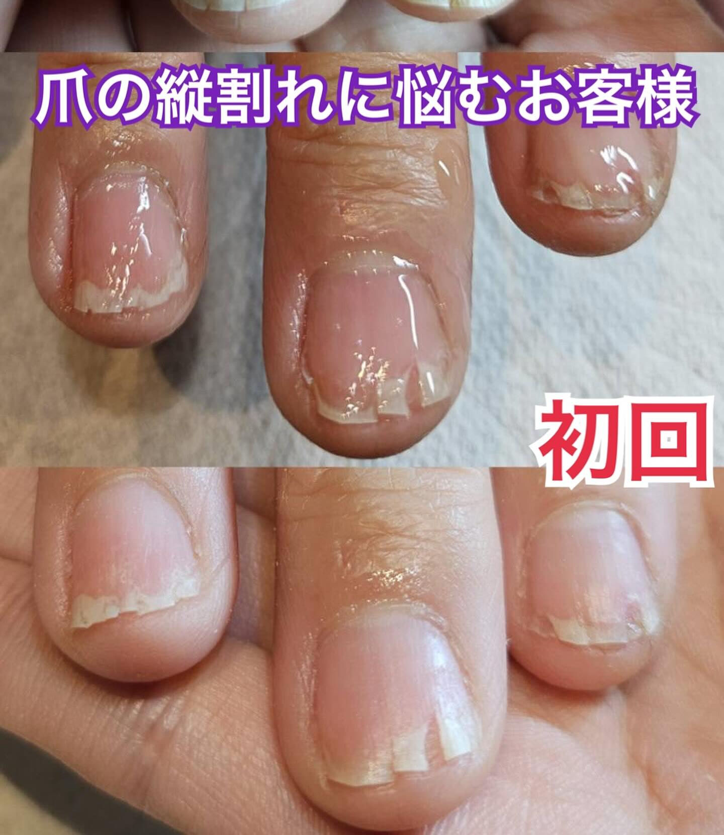 爪 縦 割れ 治し 方